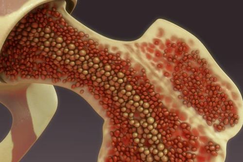 Phương thức điều trị bệnh đa u tủy xương mới dựa trên công nghệ RNA
