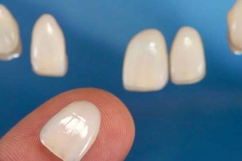 8 nhược điểm của dán sứ veneer và cách khắc phục