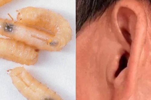 Giòi làm tổ trong tai người đàn ông