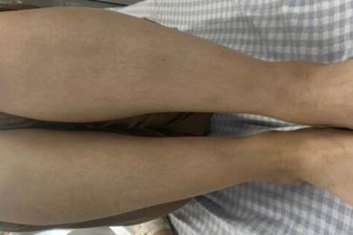 Người phụ nữ gặp biến chứng nguy hiểm sau 5 năm uống thuốc tránh thai