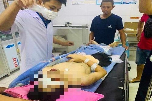 Nam sinh gần đứt lìa bàn tay, tổn thương 2 mắt sau tiếng nổ lớn