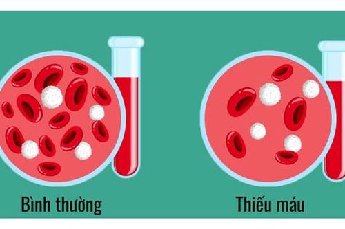Thiếu máu: Nguyên nhân, dấu hiệu và cách điều trị