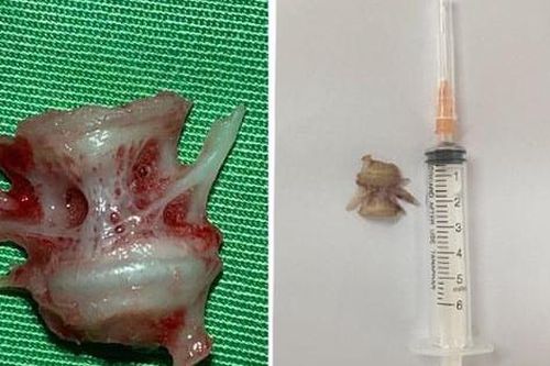 Nội soi gắp xương cá trong thực quản người phụ nữ 54 tuổi