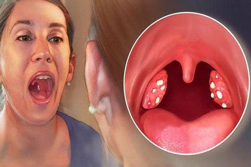 Sỏi amidan có tự khỏi không, gây biến chứng gì?
