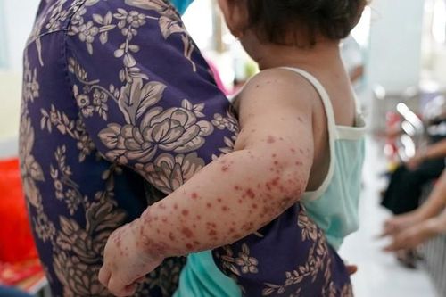 TP.HCM: Trừ điểm địa phương có ca tử vong do sốt xuất huyết, tay chân miệng