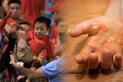 Từ vụ bé trai bị bỏng do pháo sáng trên sân Hàng Đẫy: Bác sĩ lưu ý khi xử trí vết bỏng
