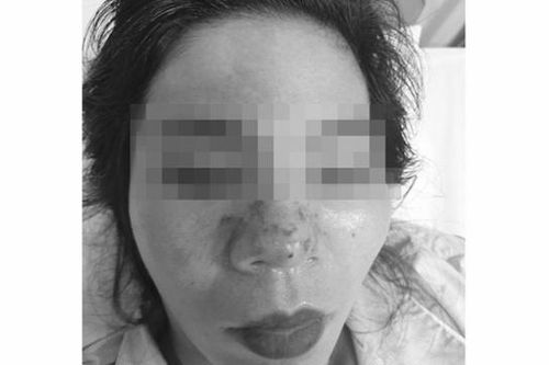 Bị mờ mắt sau khi tiêm filler tại 'Xinh Beauty & Academy'