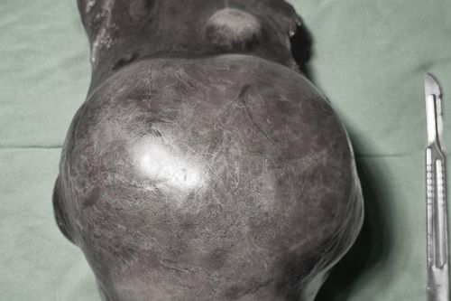 Bệnh nhân 73 tuổi mắc khối u gan khổng lồ nặng gần 2kg
