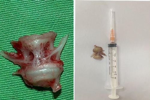 Mảnh xương cá lớn cắm sâu trong thực quản người phụ nữ 54 tuổi