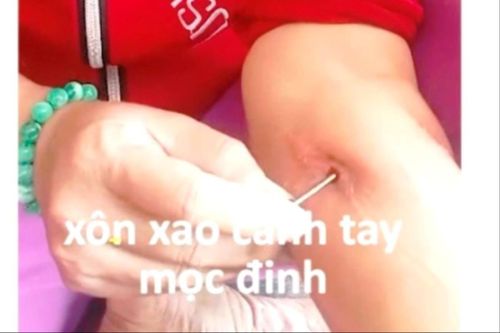 Quảng Ngãi: Không có chuyện người phụ nữ lòi đinh ra từ cánh tay