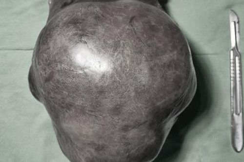 Cụ ông 73 tuổi mang trong mình khối u gan khổng lồ nặng 1,6kg