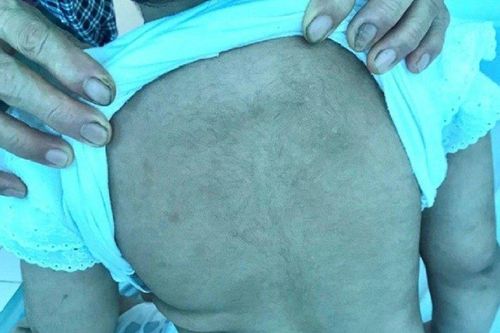 Căn bệnh khiến bé gái 4 tuổi người mọc nhiều lông, tăng cân bất thường