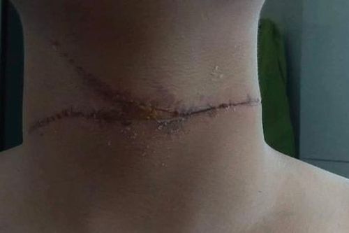 Dây diều cứa cổ người đi đường, chém rách cản trước xe ô tô
