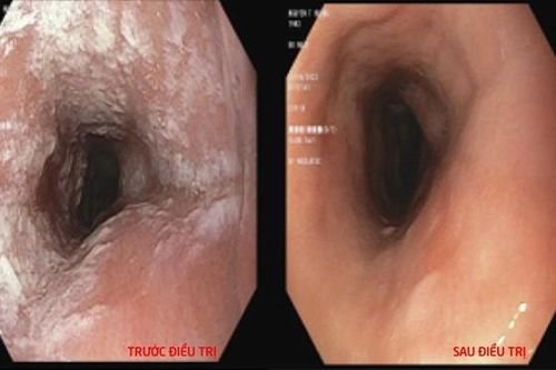 Người phụ nữ mắc nấm thực quản vì thường xuyên tự ý dùng kháng sinh tại nhà