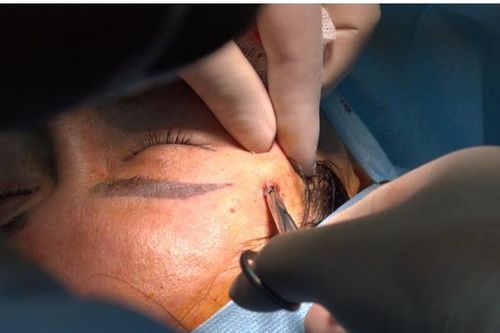 Nguy cơ đột quỵ, mù mắt sau tiêm filler làm đẹp