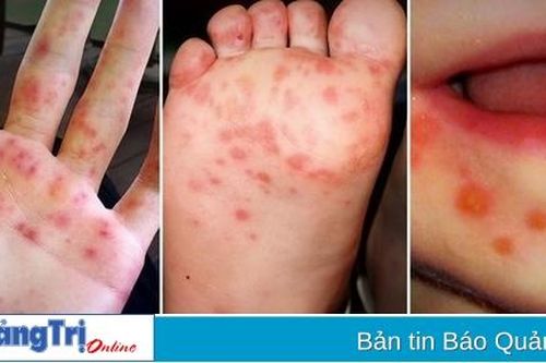 Bệnh tay - chân - miệng có xu hướng tăng nhanh
