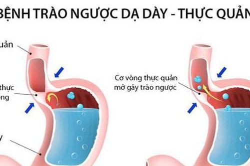Trị trào ngược dạ dày thực quản bằng thuốc đông y