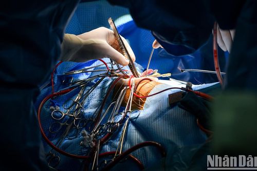 Cận cảnh ca mổ thứ 700 trường hợp tim bẩm sinh với kỹ thuật ít xâm lấn