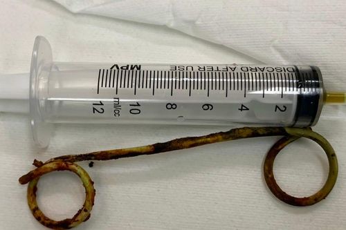 Một stent nhựa dài 15 cm bị bỏ quên trong ống mật cụ bà suốt 6 năm