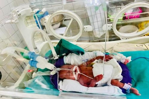 Bệnh viện Bạch Mai nuôi sống thành công trẻ sinh non nặng 400g