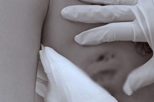 Cô gái gặp họa khi tiêm chất làm đầy nâng ngực trong khách sạn
