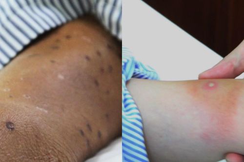 Người phụ nữ trẻ nguy kịch vì ong đốt