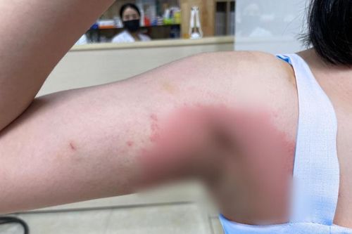 Bỏ 40 triệu đồng trị 'viêm cánh', sốc nặng khi nhìn vùng nách màu tôm luộc