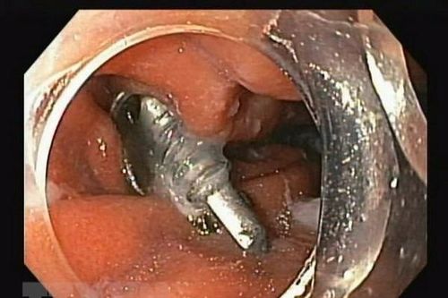 Phú Thọ: Cấp cứu thành công bé trai nuốt phải cây đinh vít nhọn