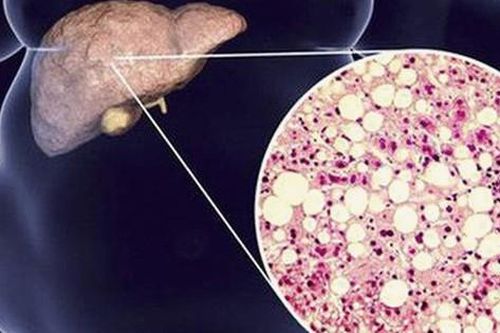 Hỏng hết gan, não, thận vì dùng thuốc giảm cân