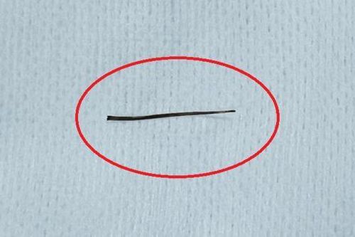 Xương cá đâm thủng ruột non cụ 83 tuổi