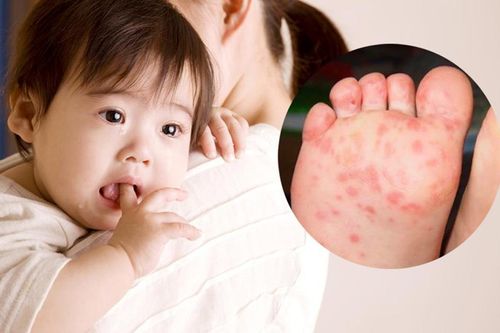 5 dấu hiệu bệnh tay chân miệng chuyển nặng cần chú ý, tránh để trẻ rơi vào suy hô hấp