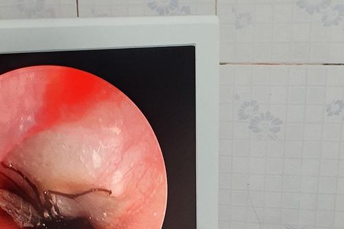 Sản phụ suýt thủng màng nhĩ vì bị gián chui vào tai