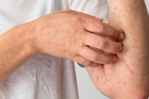 Thời tiết thay đổi khiến nhiều người tái phát viêm da cơ địa, bác sĩ khuyến cáo cách xử lý