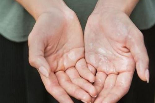 4 cách khắc phục chứng ra mồ hôi tay, mồ hôi chân hiệu quả