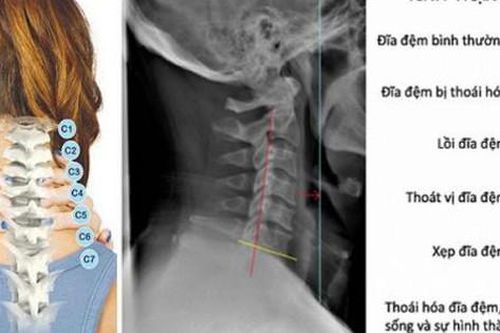 Cách làm gối thuốc chữa bệnh thoái hóa cột sống cổ