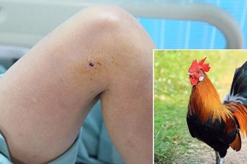Bị gà trống mổ vào đùi, một phụ nữ phải nhập viện cấp cứu