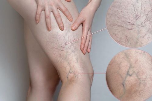 Bệnh suy giãn tĩnh mạch có thể gây tử vong