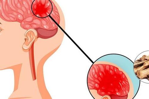 5 vị thuốc trị thiếu máu não, cách sử dụng và lưu ý khi dùng