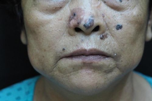 Loại ung thư ác tính, xuất hiện ở cả miệng và cơ quan sinh dục