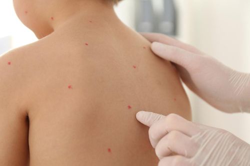 Cảnh báo bệnh thủy đậu và biến chứng nguy hiểm
