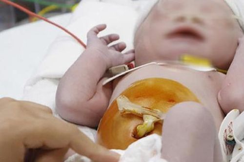Khoảng 10.000 trẻ được sinh ra mắc tim bẩm sinh, làm sao để ngăn ngừa?
