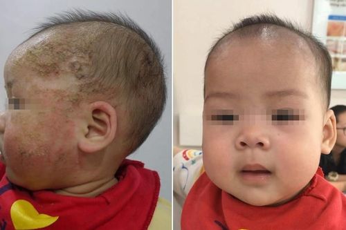 Bé 8 tháng tuổi biến chứng nặng do điều trị viêm da cơ địa bằng tắm lá