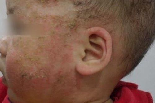 Trị viêm da cơ địa bằng tắm lá, bé 8 tháng tuổi biến chứng nặng