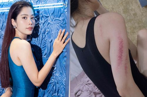 Nam Em lộ rõ thân hình gầy gò, nhiều vết bầm tím trên cơ thể khiến fan lo lắng