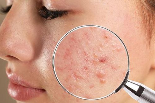 Mụn do nội tiết tố xử lý như thế nào?