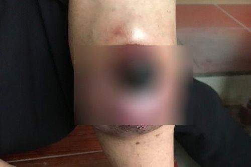 Có khối u như vảy ốc, đi khám bất ngờ nhận kết quả ung thư