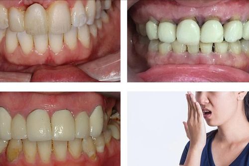 Sự thật về những biến chứng khi bọc răng sứ
