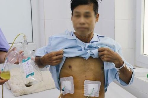Mệt mỏi kéo dài, người đàn ông tá hỏa khi thấy sán lá gan chui ra từ trong dịch mật