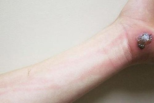 Tự nặn mụn ở tay, nam thanh niên 20 tuổi nhập viện cảnh giác với căn bệnh nguy hiểm này