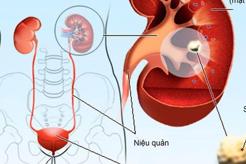 Sỏi thận - phát hiện mới và những ngộ nhận cần tránh
